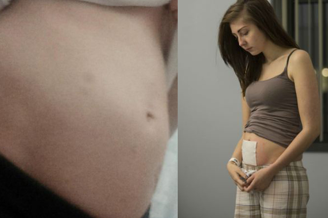 На седьмом месяце от супа: Девушка беременнеет после каждого приема пищи