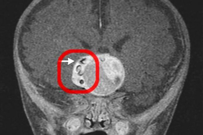 МРТ головного мозга необычного малыша