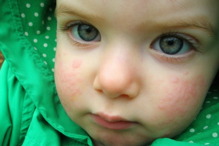 Аллергия на лице у ребенка, фото