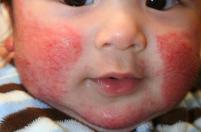 Холодовая аллергия у детей, фото