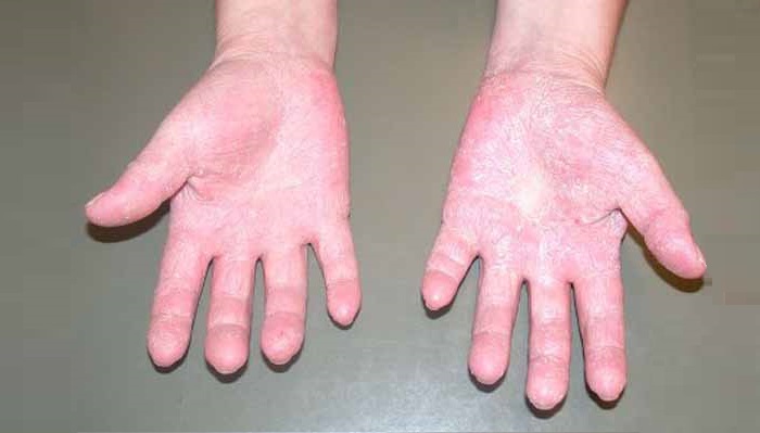 аллергия на холод симптомы фото у детей