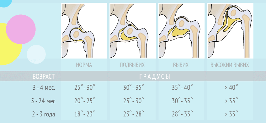 Дисплазия тазобедренных суставов у детей: лечение, симптомы