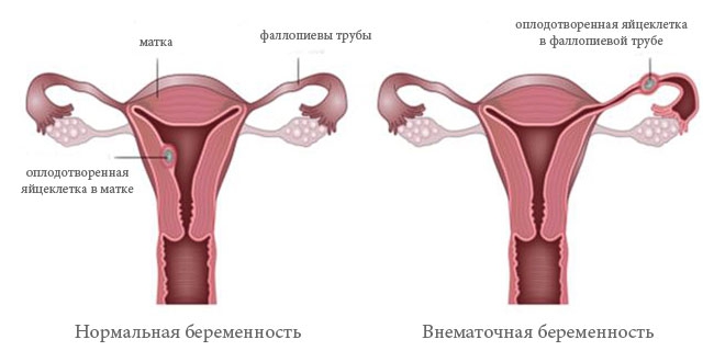 внематочная беременность фото