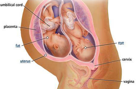 Часто маловодие наблюдается при многоплодной беременности